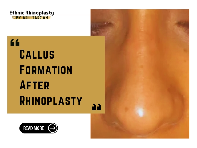 Callus Formation After Rhinoplasty