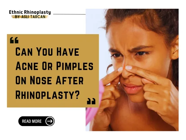 Can You Have Acne Or Pimples On Nose After Rhinoplasty