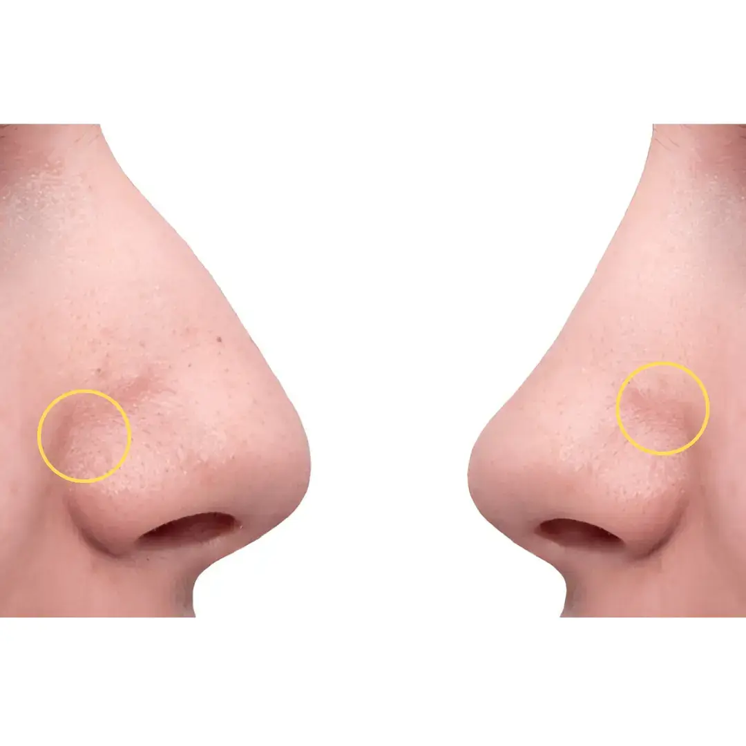 Can You Have Acne Or Pimples On Nose After Rhinoplasty Can You Have Acne Or Pimples On Nose After Rhinoplasty