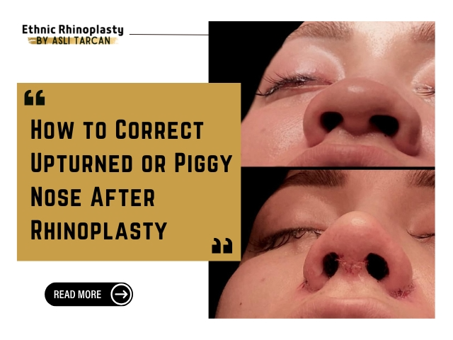 How to Correct Upturned or Piggy Nose After Rhinoplasty