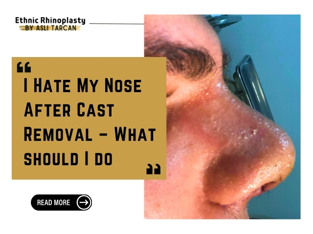I Hate My Nose After Cast Removal