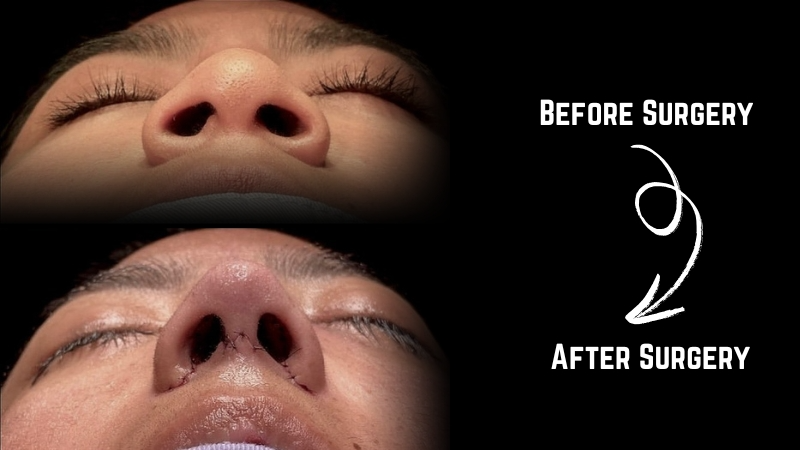 Recovery and Aftercare After Columelloplasty Recovery and Aftercare After Columelloplasty