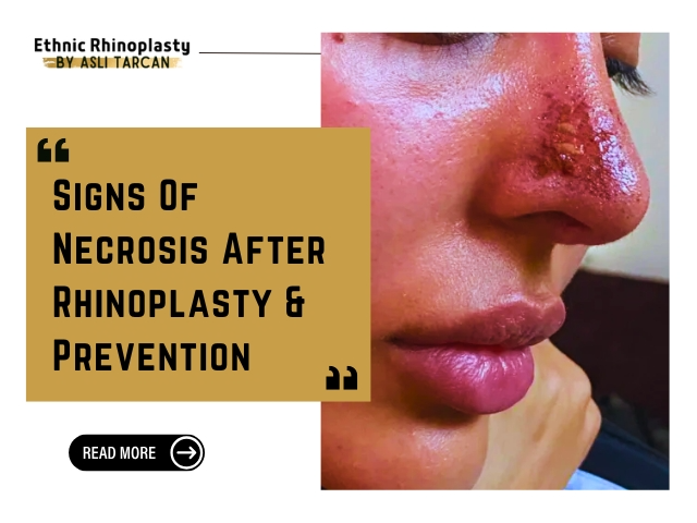 Signs Of Necrosis After Rhinoplasty