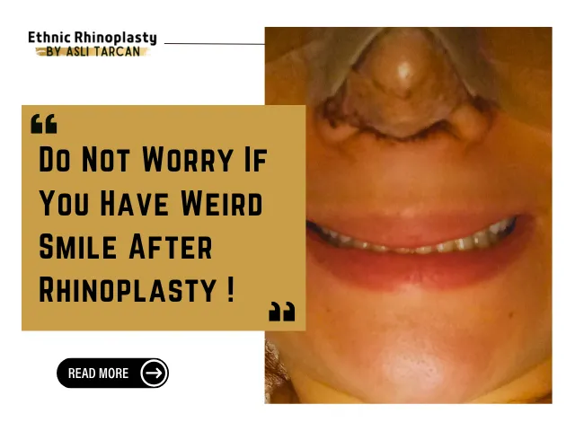 Weird Smile After Rhinoplasty