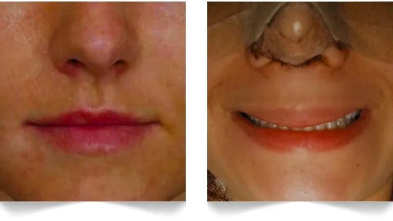 What Are The Main Causes of a Weird Smile After Rhinoplasty