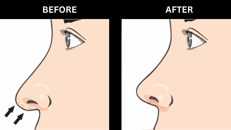 What the Columella Is and Its Role in the Nose's Appearance What the Columella Is and Its Role in the Nose's Appearance