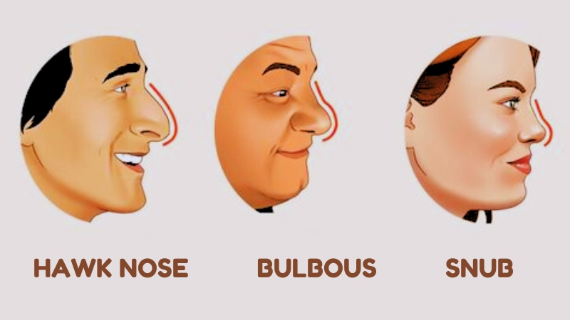 What Are Common Nose Types Among Caucasians?