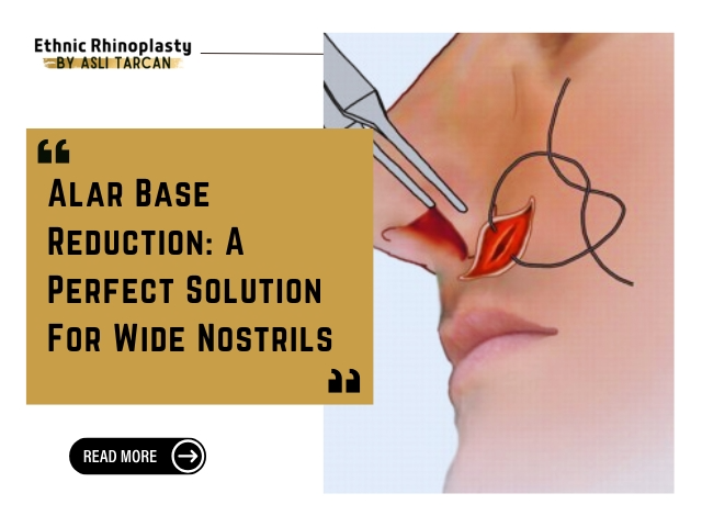 Alar Base Reduction A Perfect Solution For Wide Nostrils