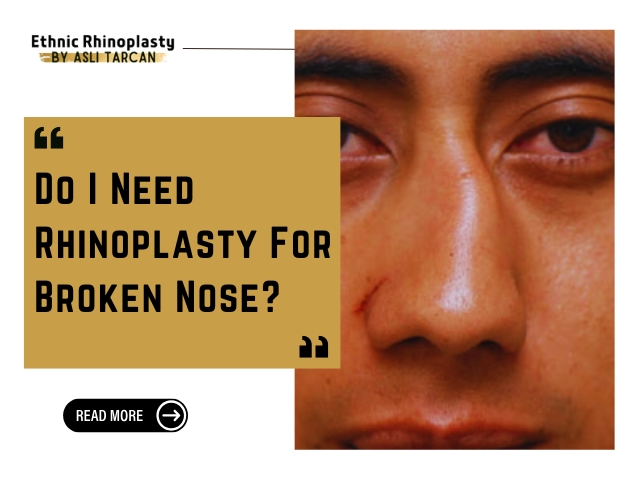 Rhinoplasty For Broken Nose