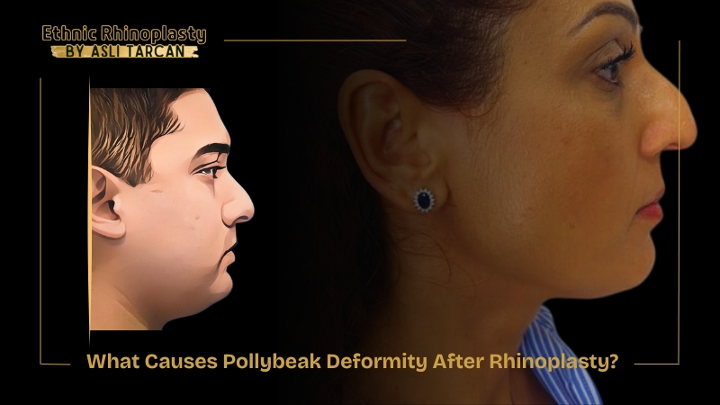 What Causes Pollybeak Deformity After Rhinoplasty What Causes Pollybeak Deformity After Rhinoplasty