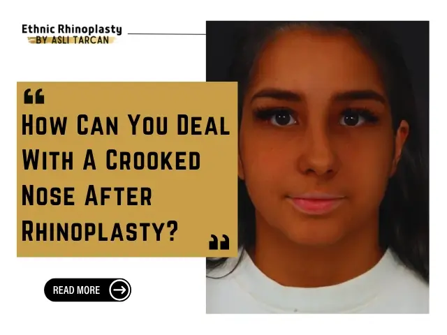 Crooked Nose After Rhinoplasty