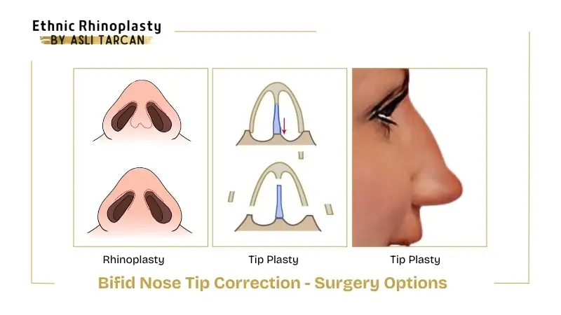 Bifid Nose Tip Correction - Surgery Options Bifid Nose Tip Correction - Surgery Options