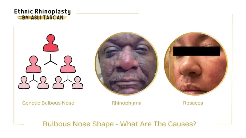 Bulbous Nose Shape causes Bulbous Nose Shape causes