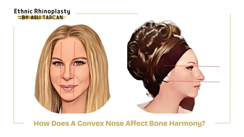 How Does A Convex Nose Affect Bone Harmony How Does A Convex Nose Affect Bone Harmony