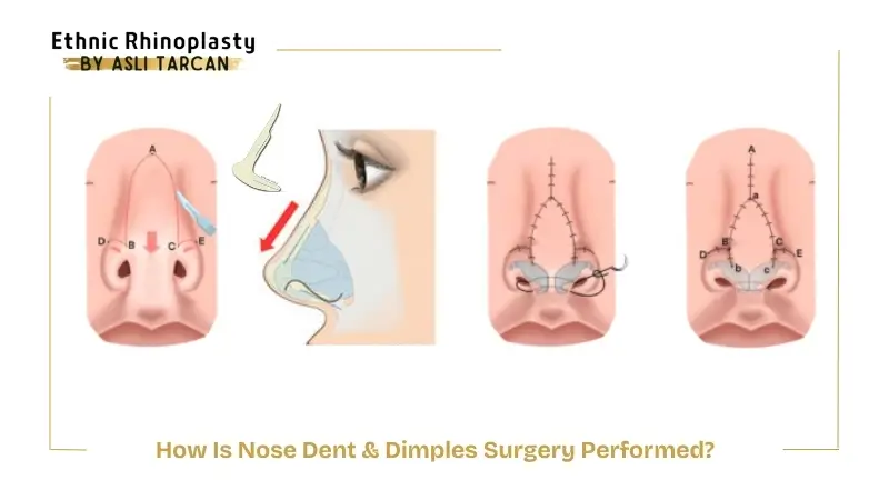 How Is Nose Dent & Dimples Surgery Performed How Is Nose Dent & Dimples Surgery Performed