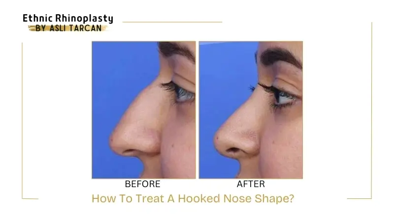 How To Treat A Hooked Nose Shape? How To Treat A Hooked Nose Shape?