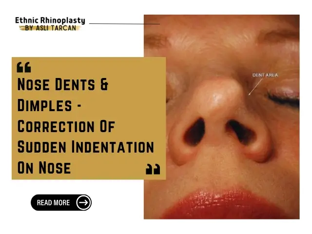 Nose Dents & Dimples