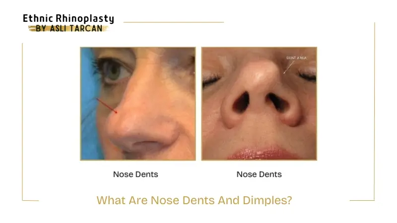 What Are Nose Dents And Dimples What Are Nose Dents And Dimples