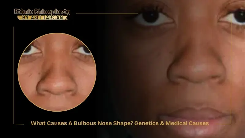 What Causes A Bulbous Nose Shape Genetics & Medical Causes What Causes A Bulbous Nose Shape Genetics & Medical Causes