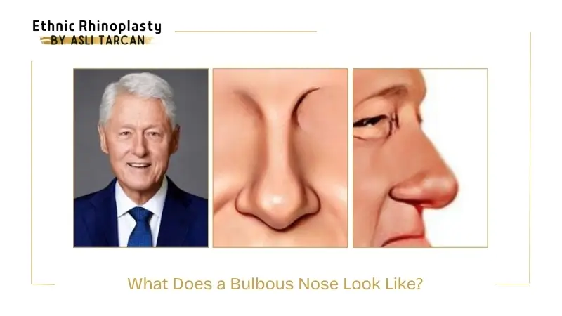 What Does a Bulbous Nose Look Like What Does a Bulbous Nose Look Like