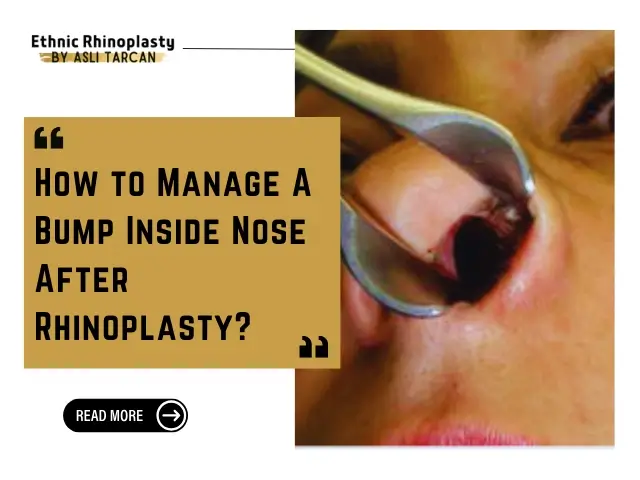 Bump Inside Nose After Rhinoplasty