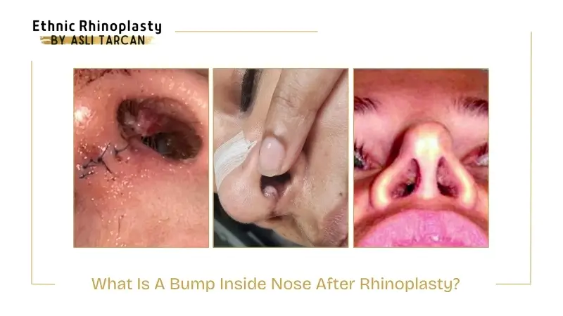 How to Manage A Bump Inside Nose After Rhinoplasty How to Manage A Bump Inside Nose After Rhinoplasty