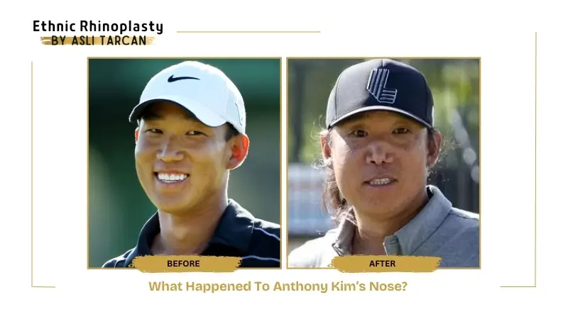 What Happened To Anthony Kim’s Nose What Happened To Anthony Kim’s Nose