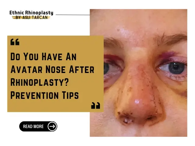 Avatar Nose After Rhinoplasty