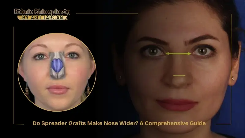 Do Spreader Grafts Make Nose Wider A Comprehensive Guide Do Spreader Grafts Make Nose Wider A Comprehensive Guide