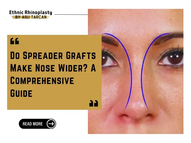 Do Spreader Grafts Make Nose Wider