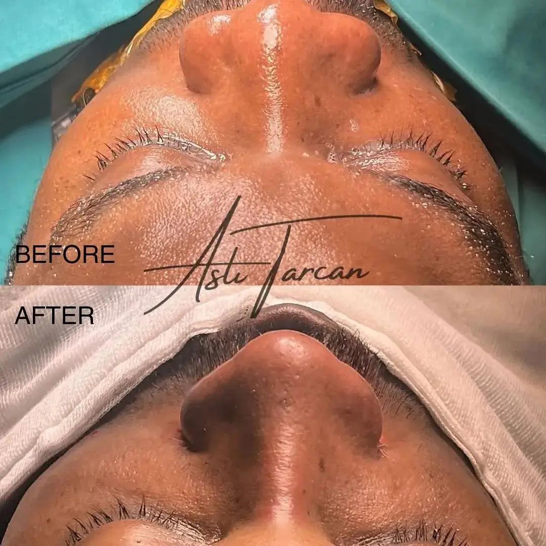 Latest Before and after of Ethnic Rhinoplasty Latest Before and after of Ethnic Rhinoplasty