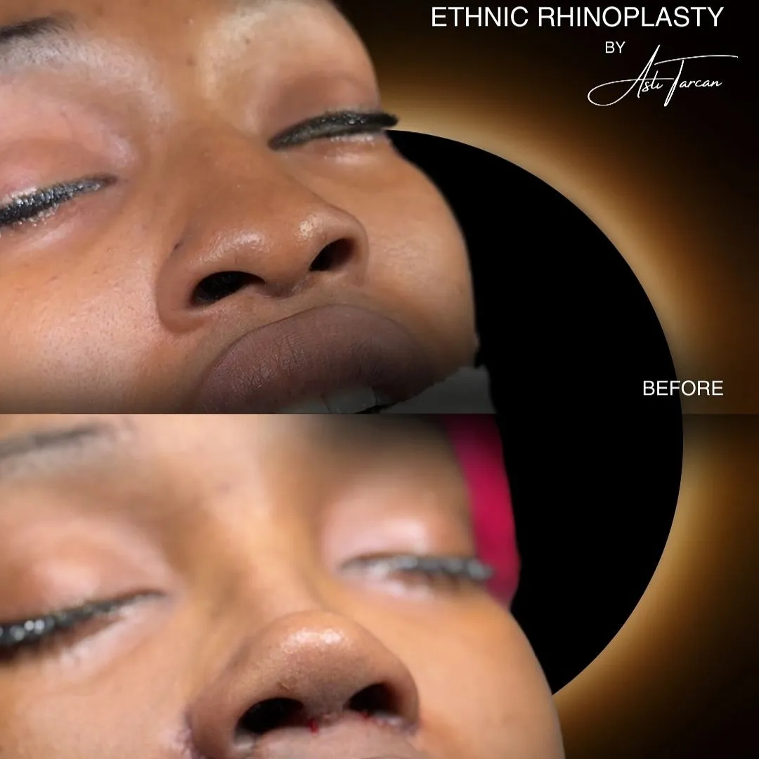 New Ethnic Rhinoplasty before and after New Ethnic Rhinoplasty before and after