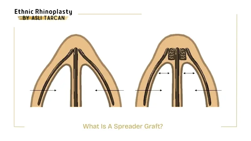 What Is A Spreader Graft What Is A Spreader Graft
