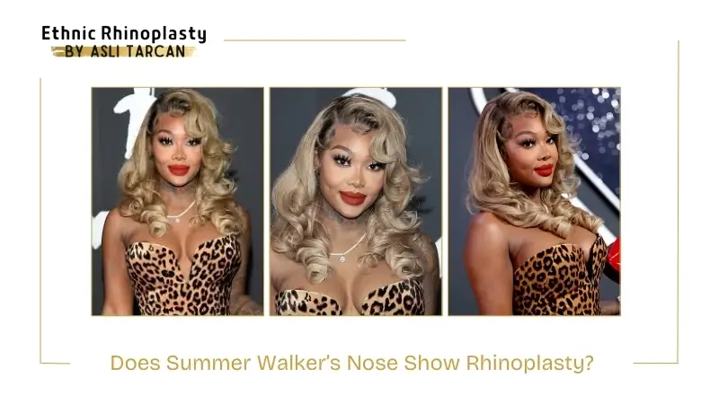 Does Summer Walker’s Nose Show Rhinoplasty Does Summer Walker’s Nose Show Rhinoplasty