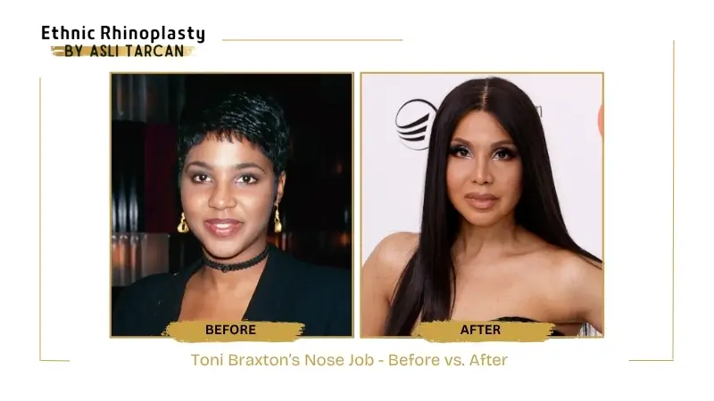 Toni Braxton’s Nose Job - Before vs. After Toni Braxton’s Nose Job - Before vs. After