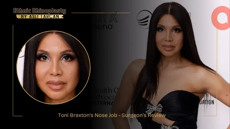 Toni Braxton’s Nose Job - Surgeon’s Review Toni Braxton’s Nose Job - Surgeon’s Review