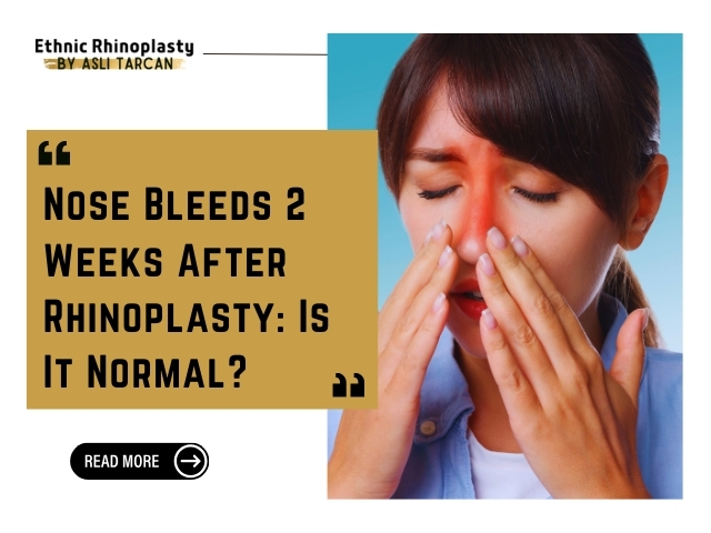 Nose Bleeds 2 Weeks After Rhinoplasty