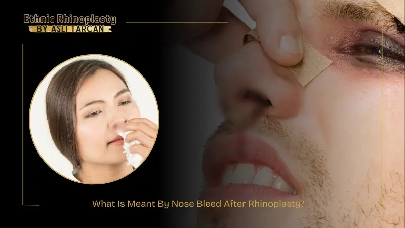 What Is Meant By Nose Bleed After Rhinoplasty What Is Meant By Nose Bleed After Rhinoplasty